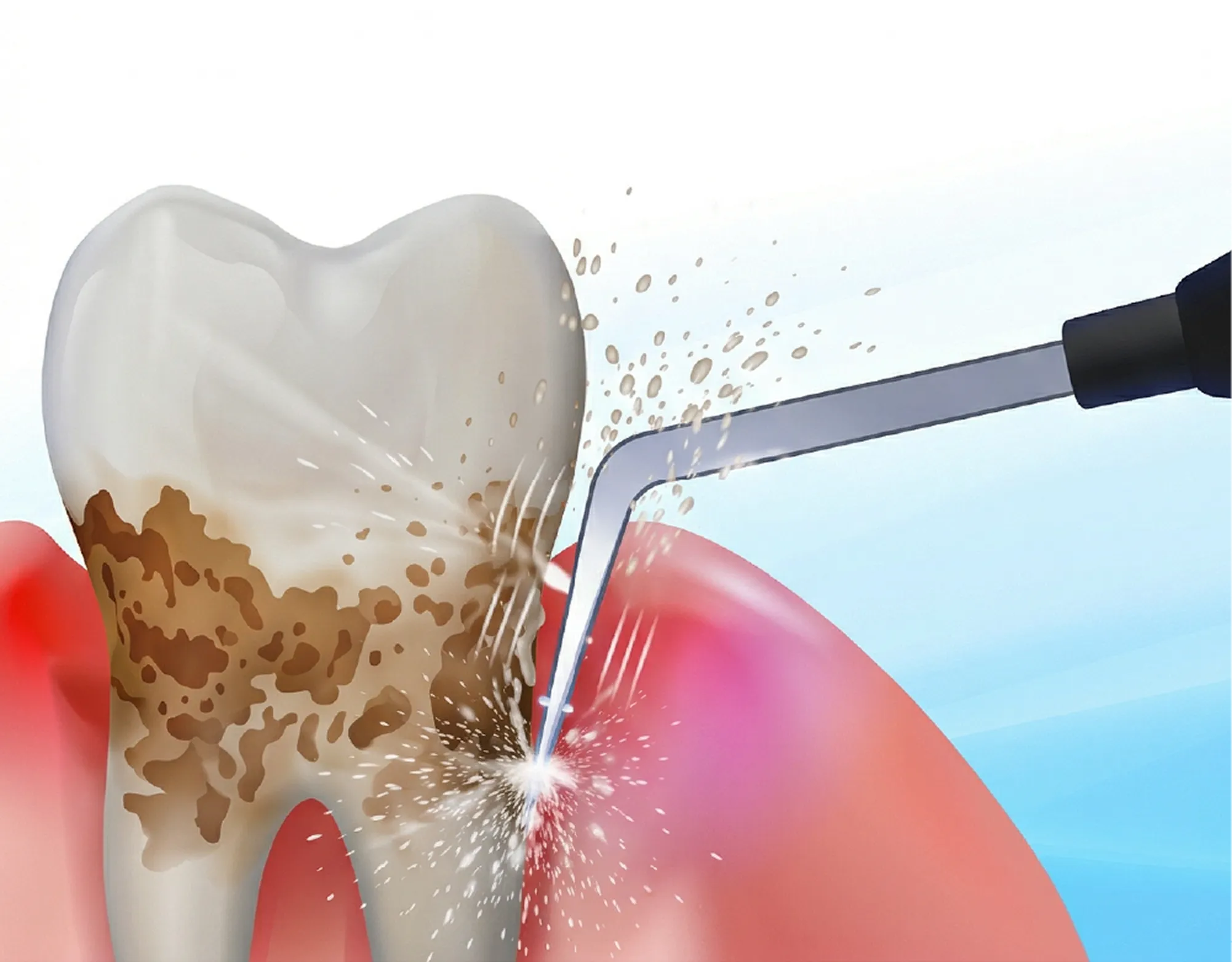 従来の歯周病治療