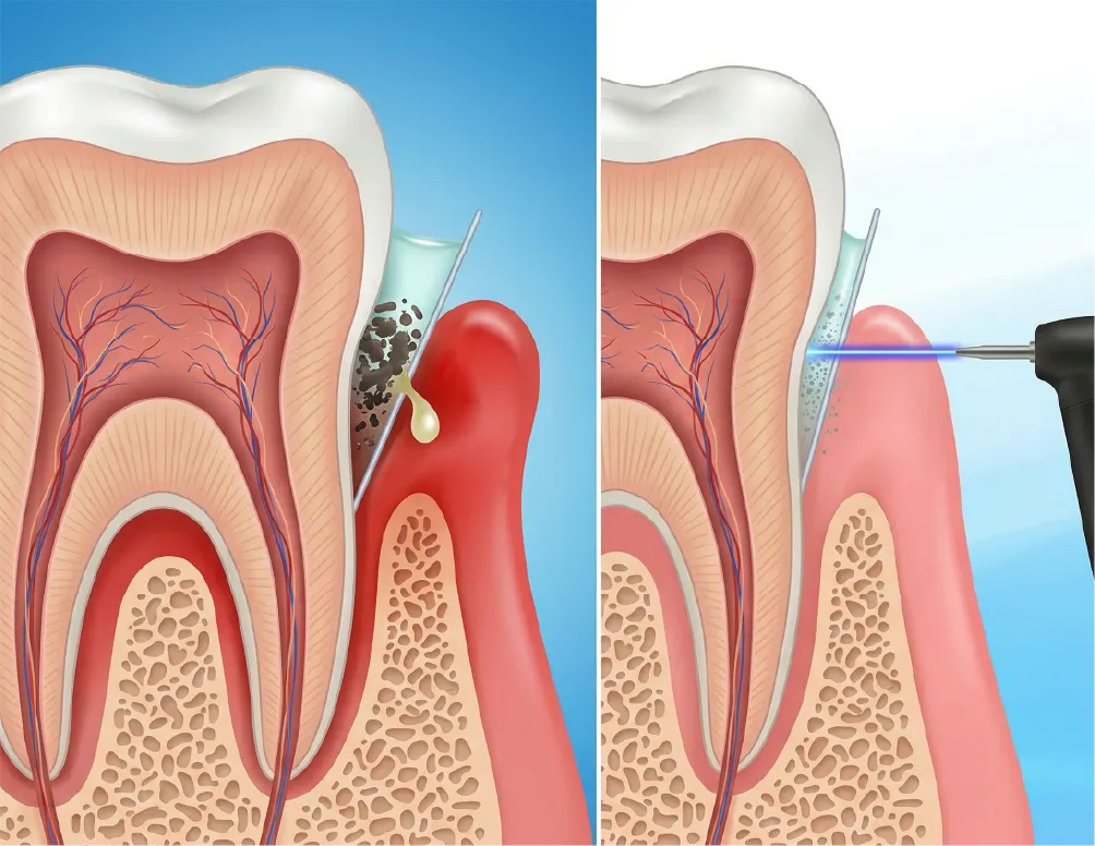 歯周ポケット・炎症・排膿