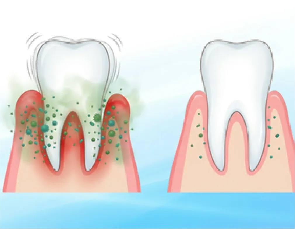 歯のぐらつきを軽減