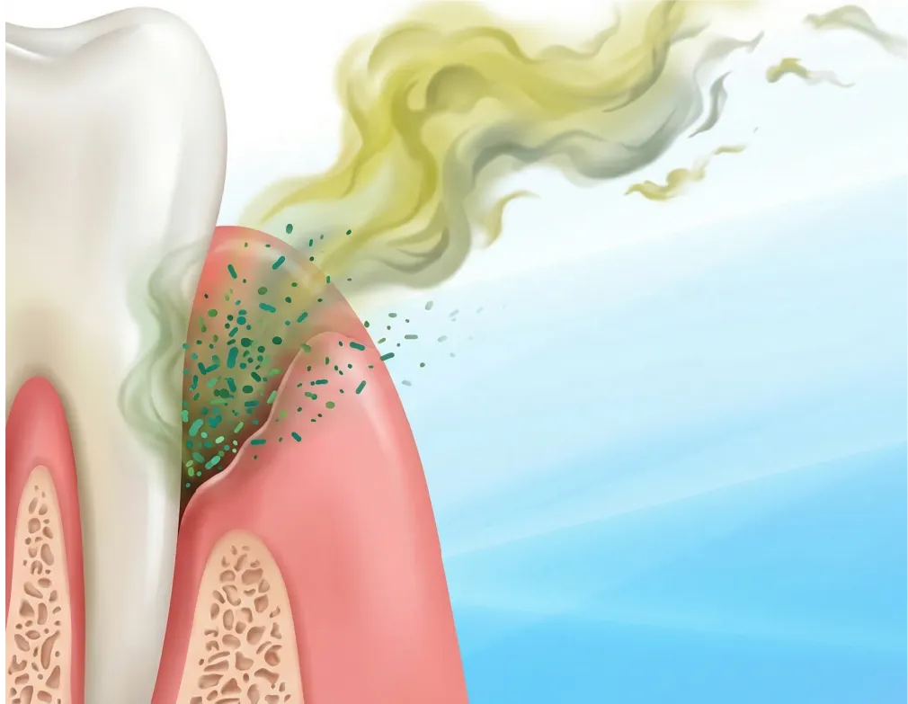 口臭・出血の緩和