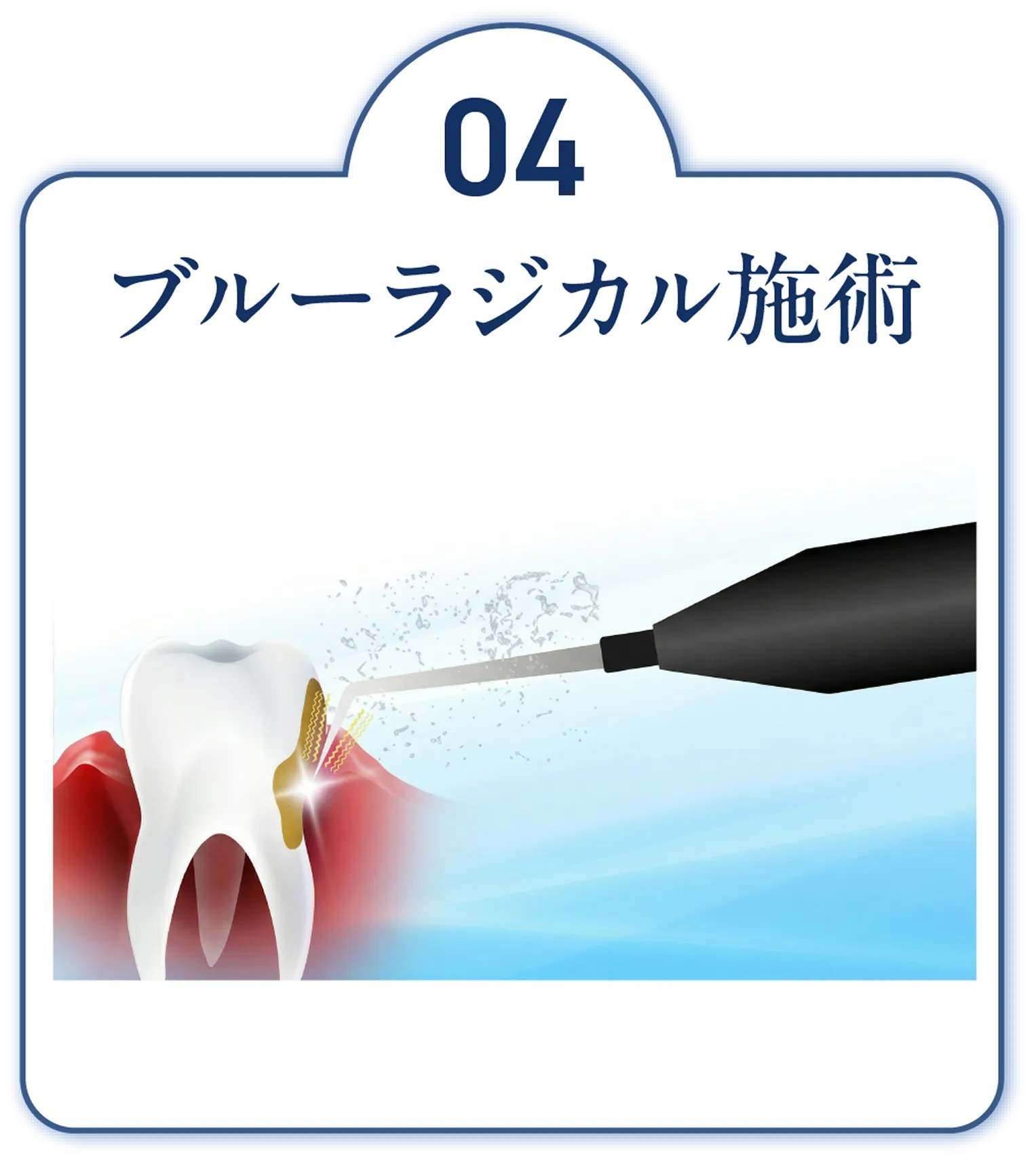 ブルーラジカル施術