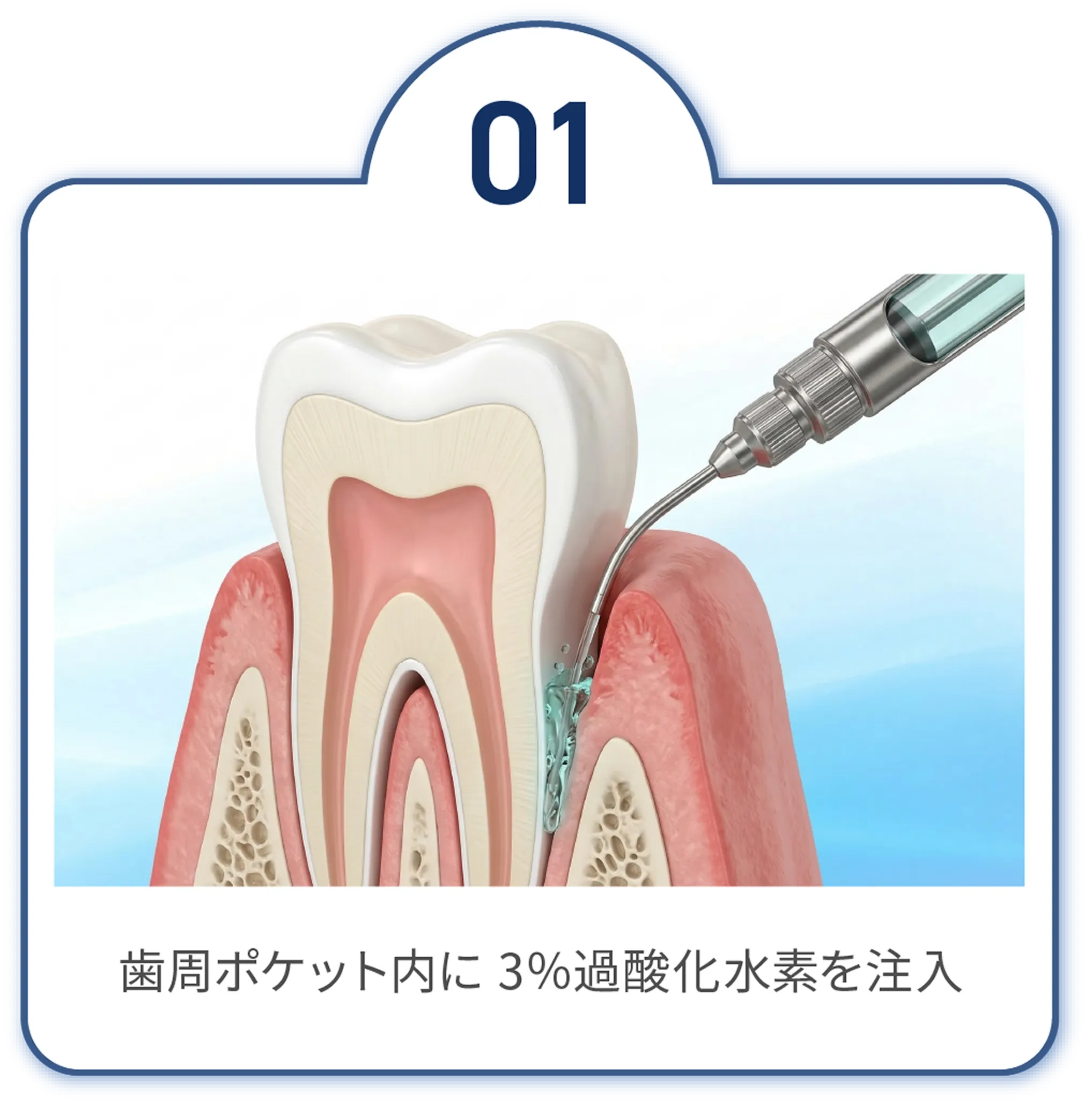 薬剤　歯周ポケット内に 3％過酸化水素を注入