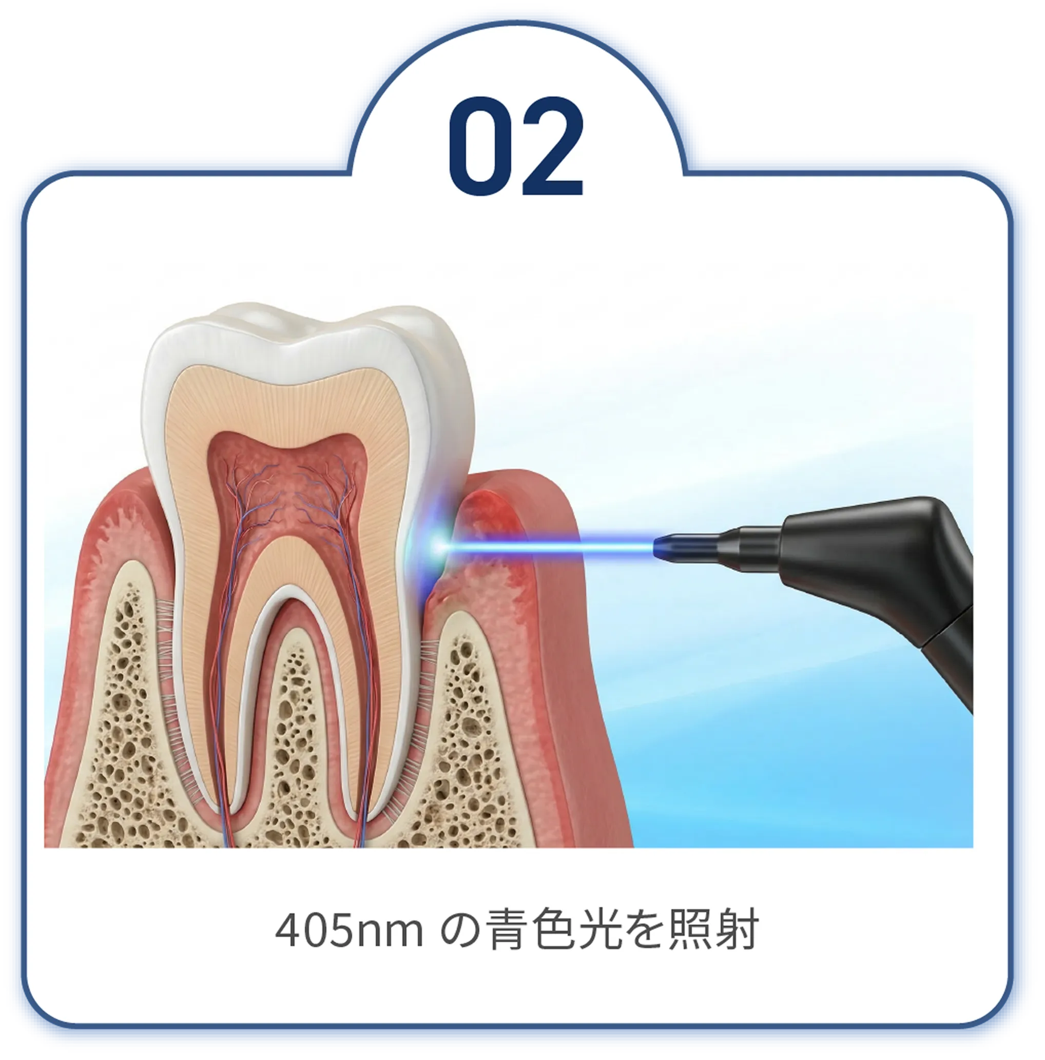 光　405nm の青色光を照射