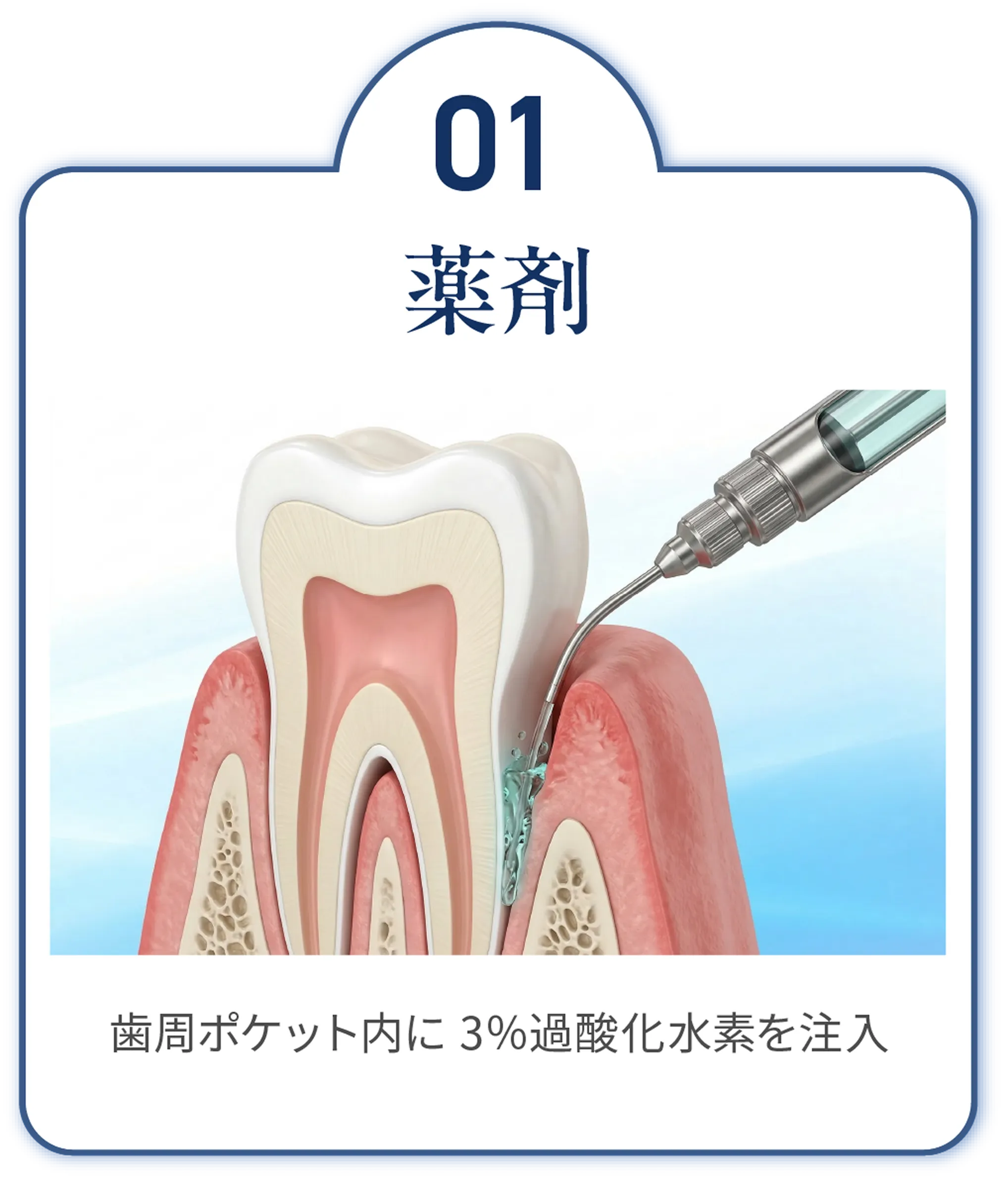 薬剤　歯周ポケット内に 3％過酸化水素を注入