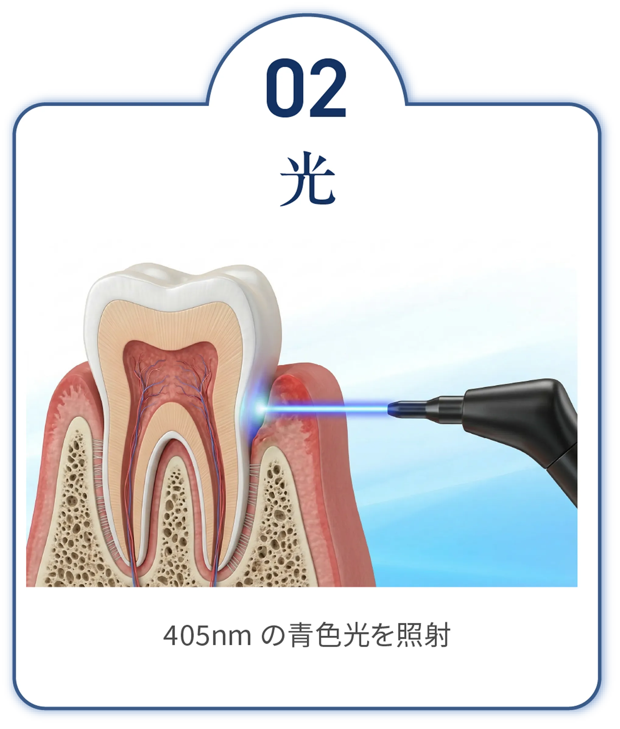 光　405nm の青色光を照射