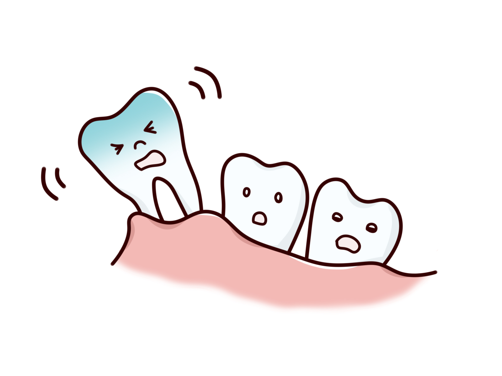 抜歯 虫歯 歯周病